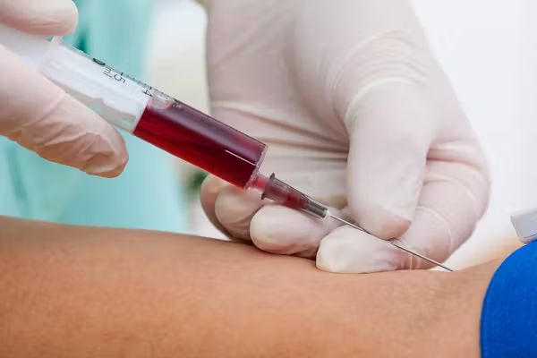 New Blood Test for Alzheimer’s Shows 90% Accuracy